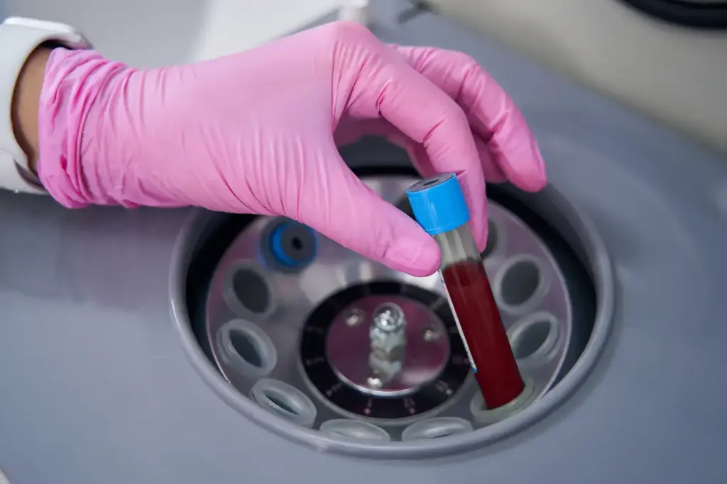 PRP’nin Doğal ve İlaçsız Bir Tedavi Olması