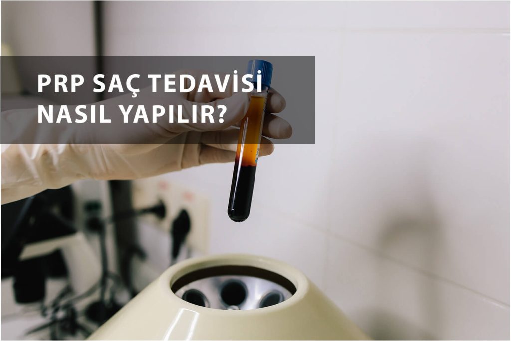 Prp saç tedavisi etkili mi