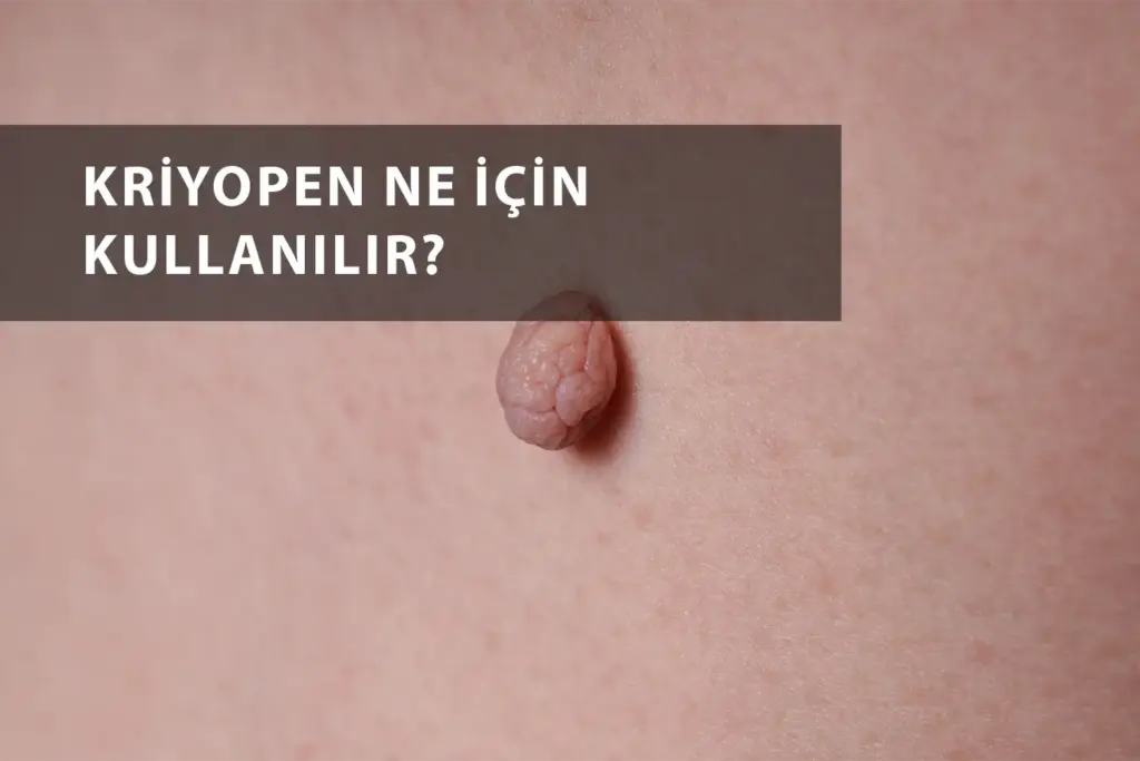 Kriyopen İle Hangi Hastalıklar Tedavi Edilir?